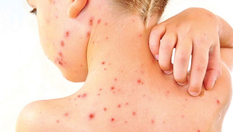 kızamık-nedenleri-belirtileri